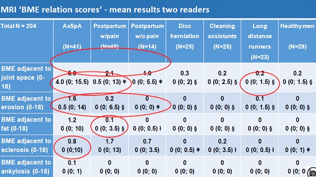 骶髂关节骨髓水肿最好的治疗方案,骶髂关节水肿是强直性脊柱炎吗