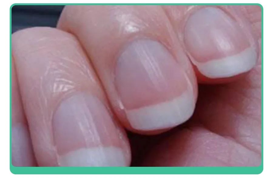 小孩指甲凹陷变黑有坑是什么原因,小孩指甲有白点和细纹是怎么回事