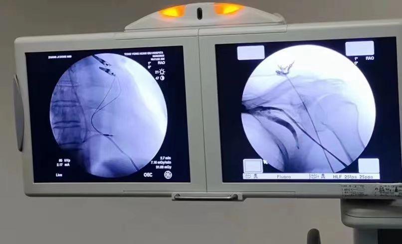 西电集团医院心内科专家,西安一附院无导线起搏器植入