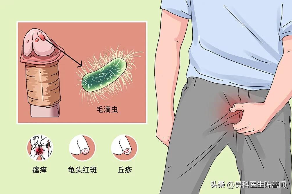 男人得滴虫病是什么症状,滴虫病是男人先得还是女人先得