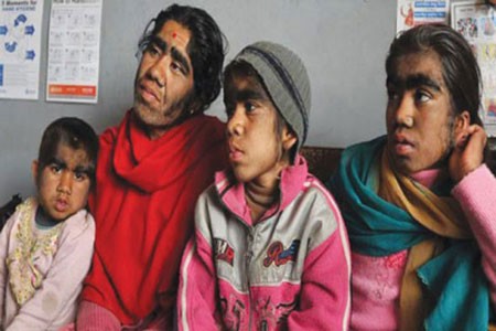 故事:非洲17岁女孩长满络腮胡,毛发从鼻孔长到脖子,身体有何异常