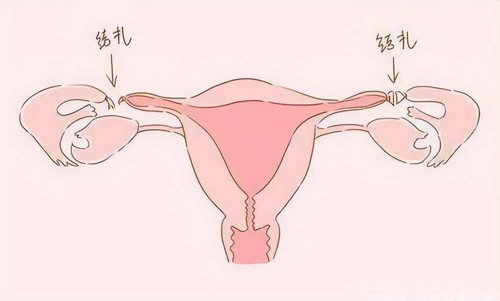 结扎多年后想再孕建议哪种方法,结扎多年还能复通吗