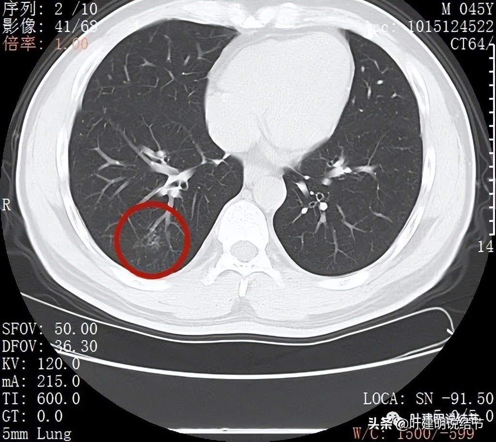 肺蜂窝状改变是肺癌吗,肺部陈旧灶与肿瘤怎么确诊