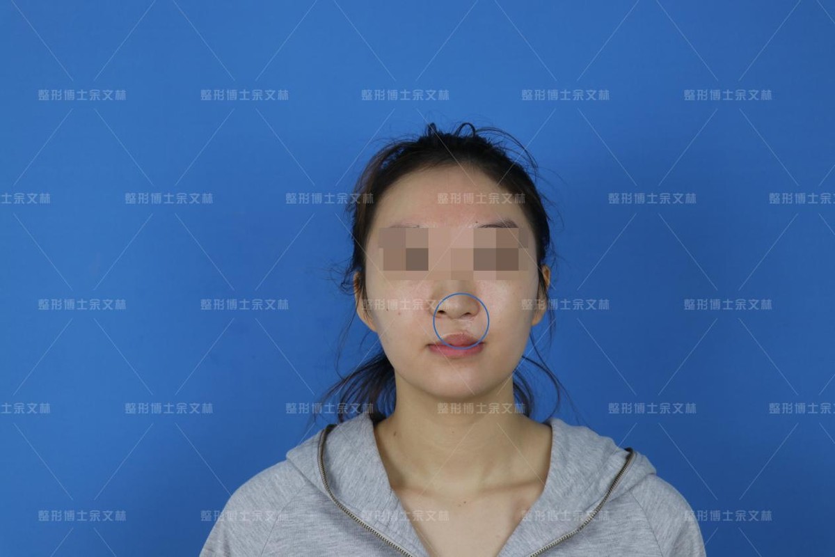 唇裂术后会出现哪些唇部畸形,唇裂造成畸形牙矫正视频