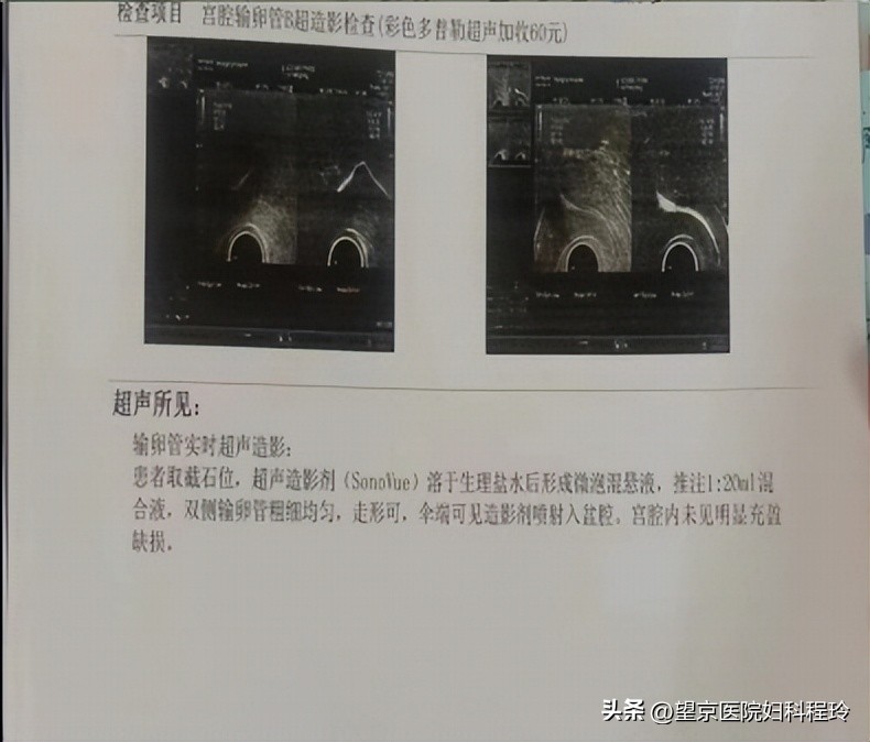 什么情况下宫外孕需要切除输卵管,宫外孕微创手术可以保住输卵管吗