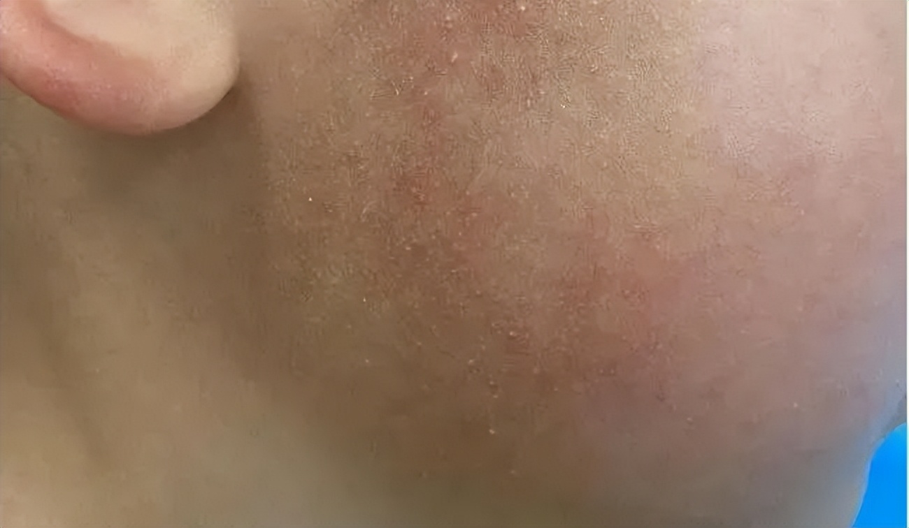 身上很多鸡皮疙瘩怎么回事,身上出现鸡皮疙瘩是什么原因