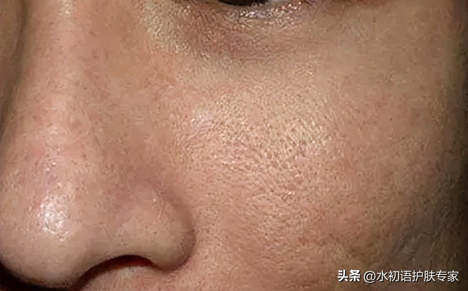 皮肤油毛孔粗大暗黄用什么护肤品,油皮毛孔粗大公认最好用的护肤水