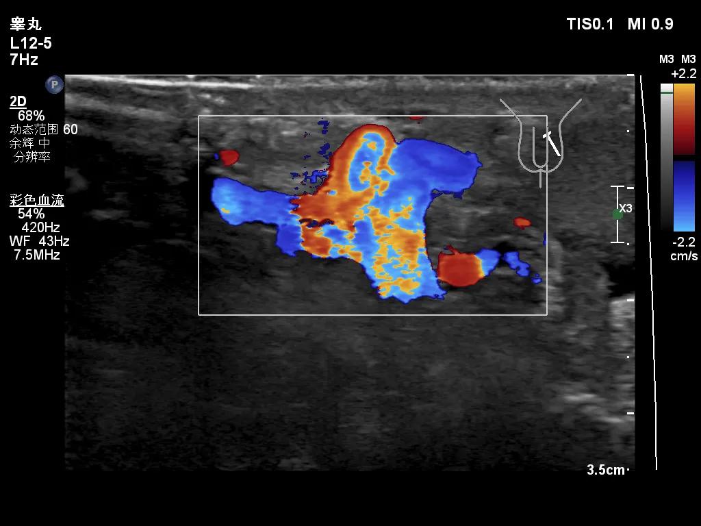 男人小腹胀下坠是什么原因,睾丸坐久隐痛是为什么