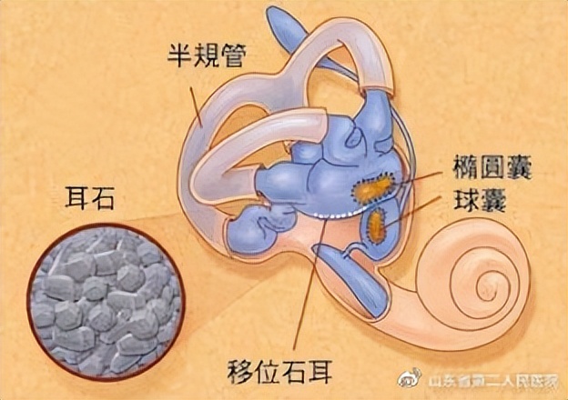 耳朵里的小石头,耳朵里像是有一个小石头