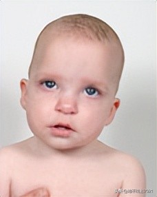 想让孩子有一个漂亮的头型，如何预防和治疗偏头与扁头？