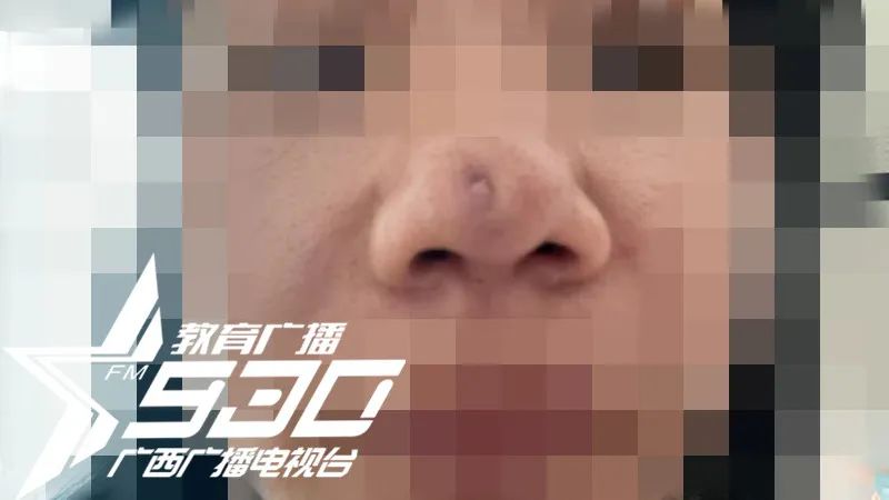 女子花1万隆鼻后山根塌陷,女子花9万多隆鼻