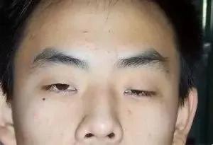 怎么判断眼皮松弛严不严重,眼皮松弛有皱纹怎么办