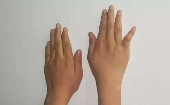 手腕无力手指笨拙虎口萎缩,手臂手掌无力萎缩的症状