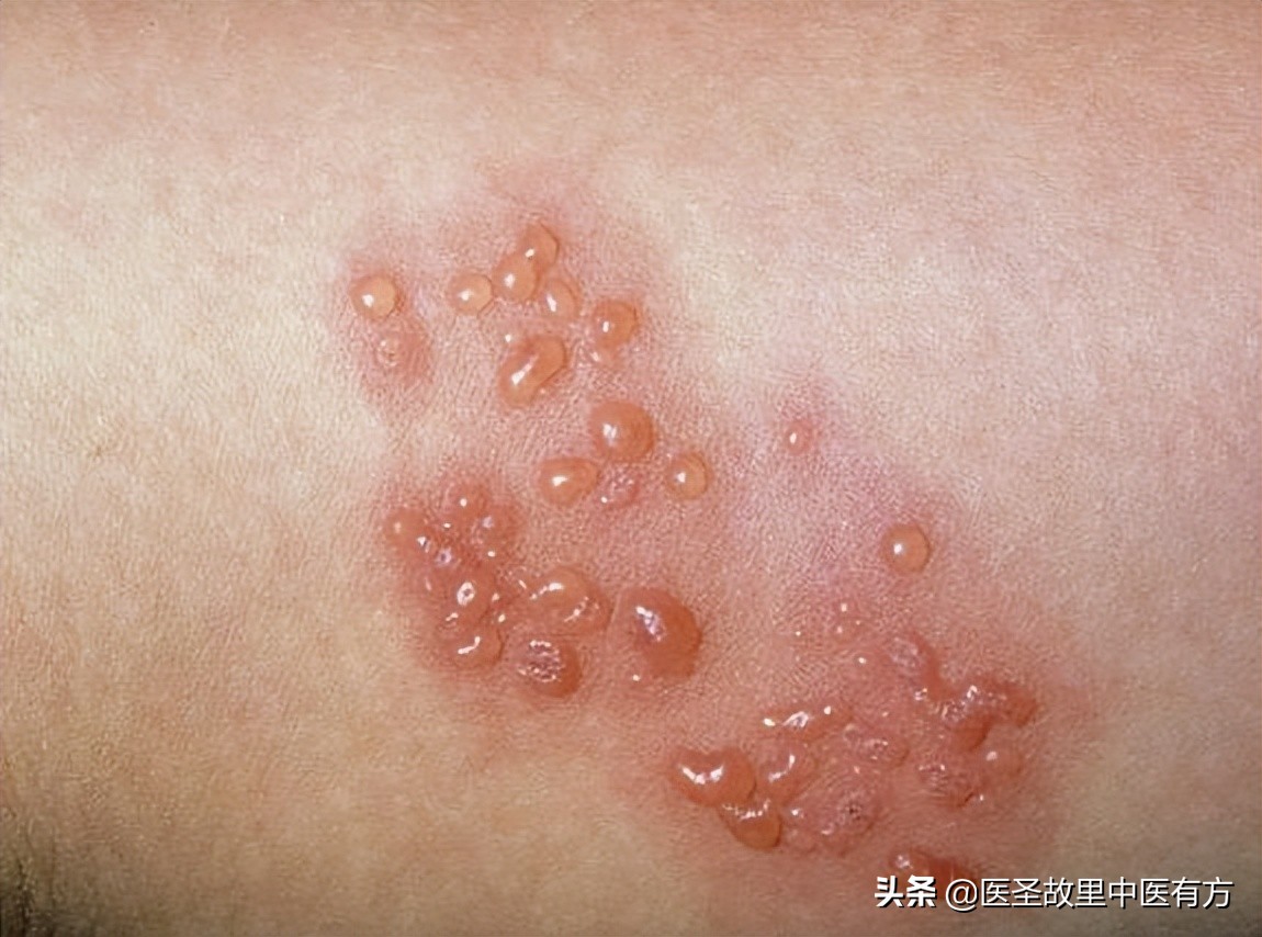 龙胆泻肝汤治荨麻疹医案,蛇缠腰中药方龙胆泻肝汤