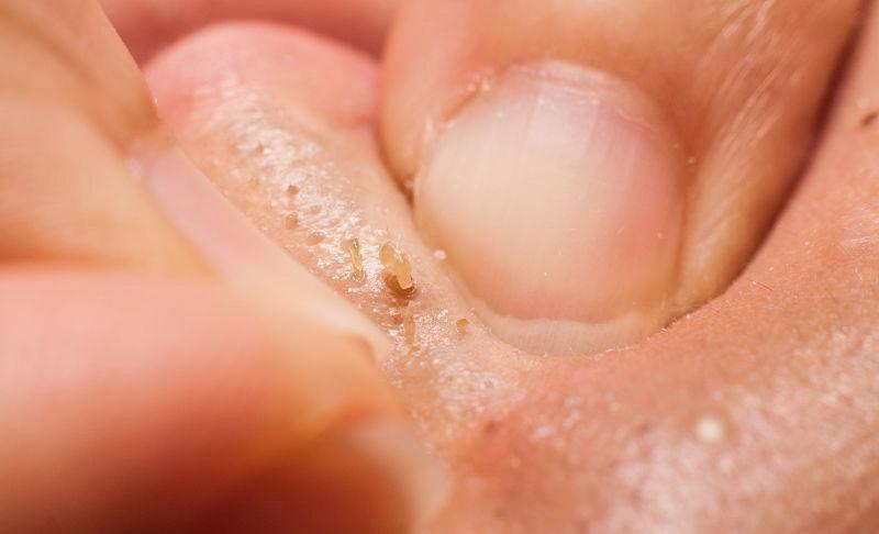 毛孔堵塞怎样才能疏通毛孔,身上毛孔堵塞不出汗怎么疏通毛孔