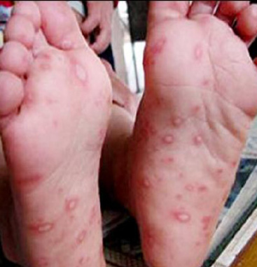 宝宝健康学堂全集,宝宝病毒感染嘴巴手脚里面长疱疹