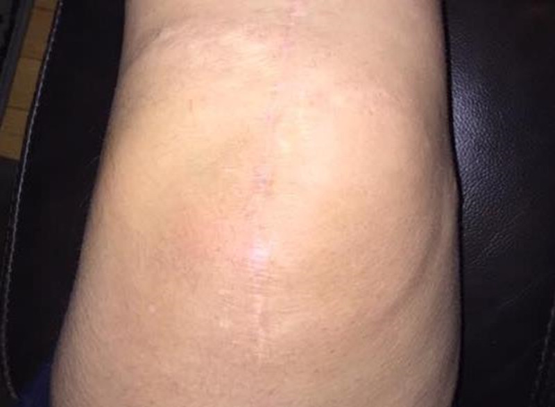 换了膝盖多长时间就不痛了,换了膝盖怎么康复