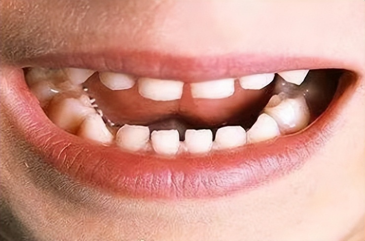 宝宝牙缝大是吃糖引起的吗,宝宝牙缝太宽了吧