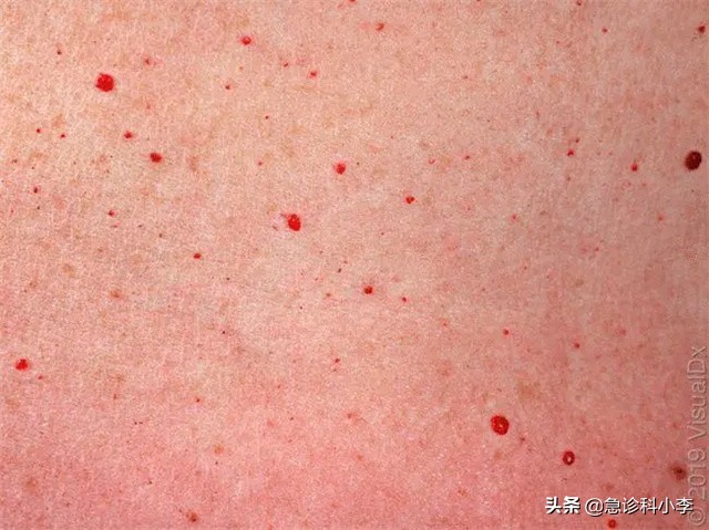 孩子身上小红点不痛不痒是什么病,身上起小红点不痛不痒按压会消失