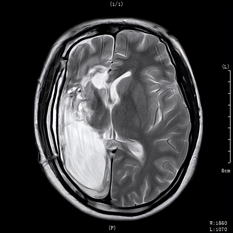 少女抗癫痫6年后终于迎来康复，顺利结婚生子，重获生命的美好