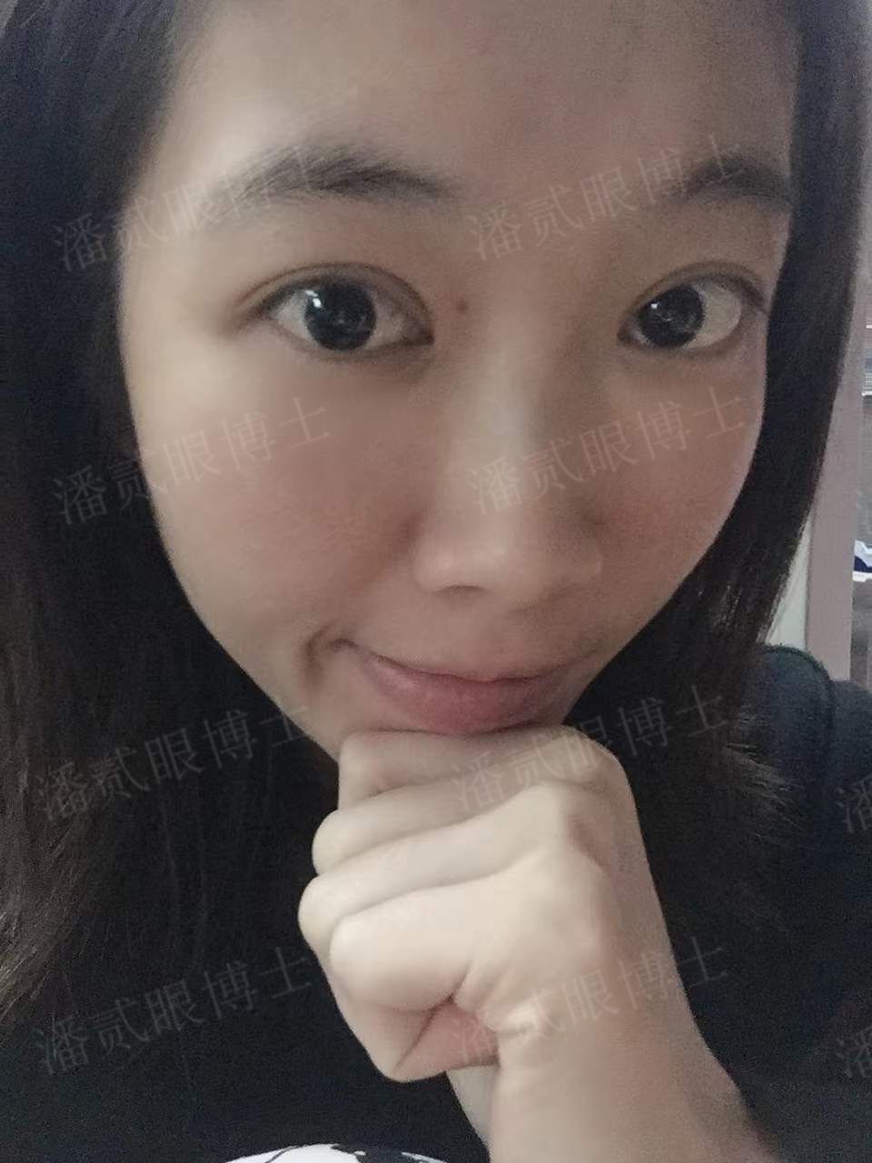 广州姑娘变美后亲述：“我的双眼皮切得很小，只有1厘米多一点”