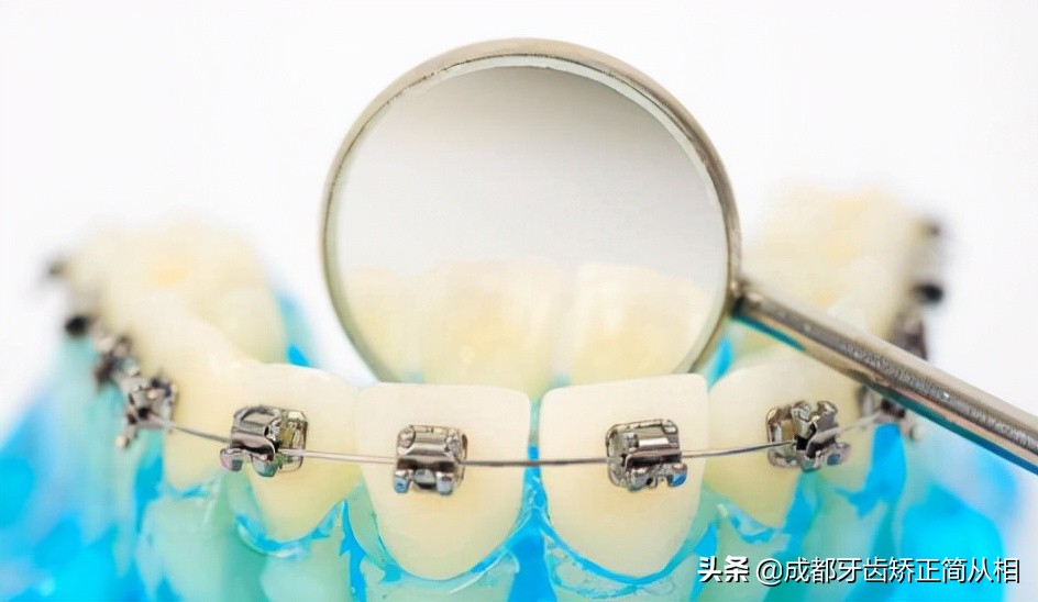 戴牙套多久不会磨嘴长溃疡,矫正牙套磨破嘴怎么办