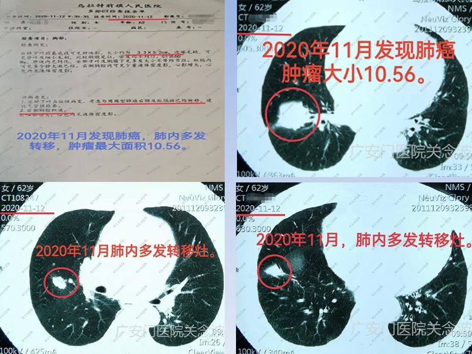 正确使用中医药治疗肿瘤才显效,关于中医中药在肿瘤治疗中的见解