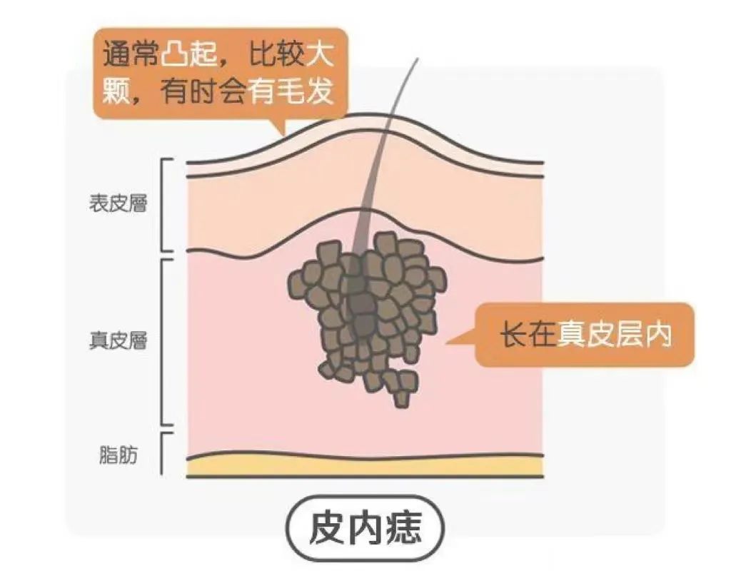 长在这3个部位的痣要当心,脸上哪个部位的痣不能随便点