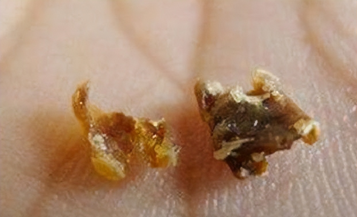 为什么有的人是油耳,糠耳与油耳的区别