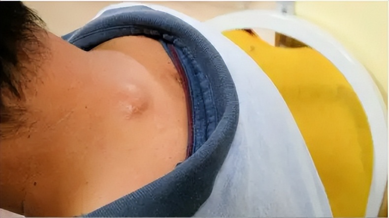 脂肪肉瘤和脂肪瘤摸着区别,脂肪瘤很常见吗