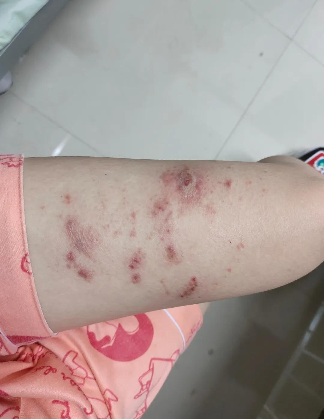 被隐翅虫毁容会好吗,隐翅虫脸上毁容