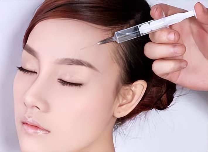 玻尿酸打额头的方法,玻尿酸打鼻子山根变宽真实案例