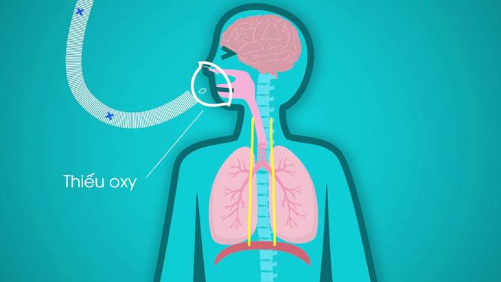 人体缺氧的典型表现是,长期缺氧的症状表现有哪些