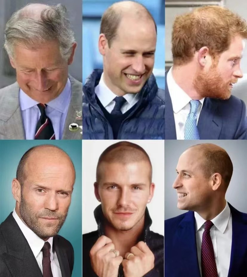 脱发脱得严重用什么防脱发,防脱要趁早改善脱发