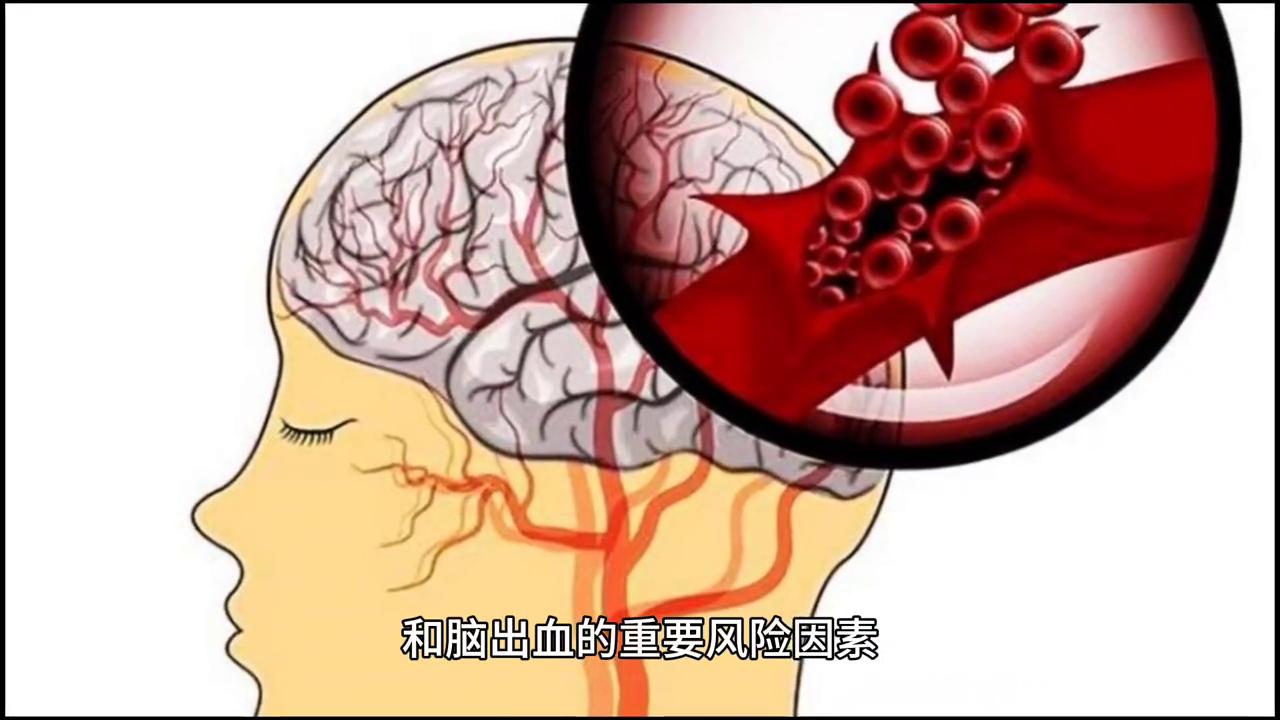 男子醉酒昏迷脑出血,男子酒后摔倒脑出血瞳孔散大后续