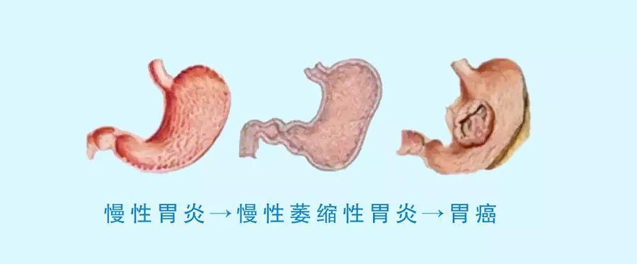 胃镜多久做一次合适正常人,胃镜多长时间做一次比较合理