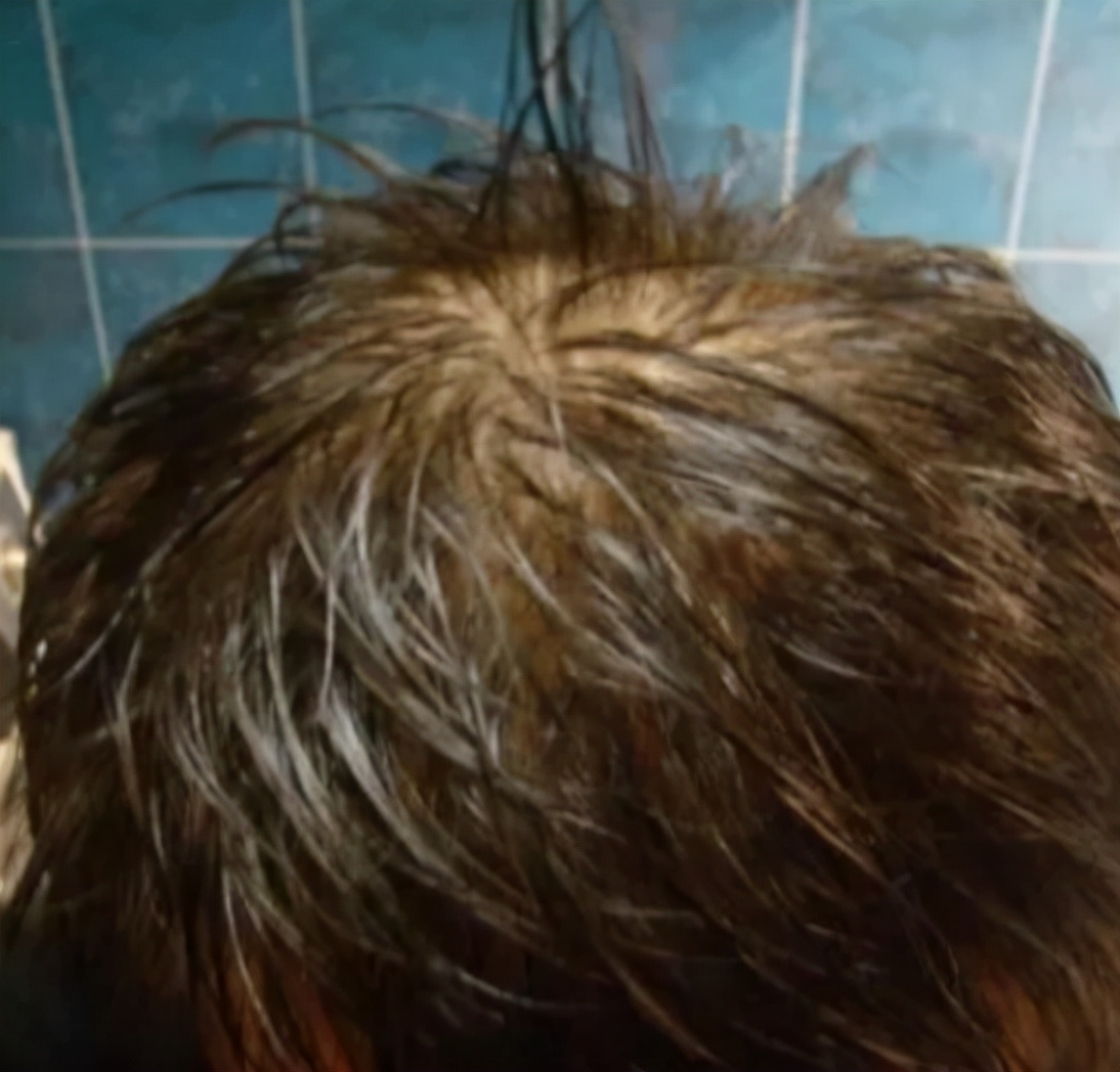 什么脱发用米诺和非那雄胺效果快,男性脱发用米诺地尔女性用什么