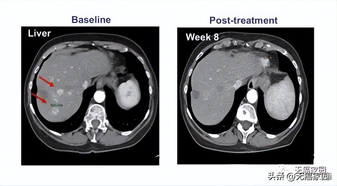 抗癌新技术真的出来了吗,最新靶向抗癌新药
