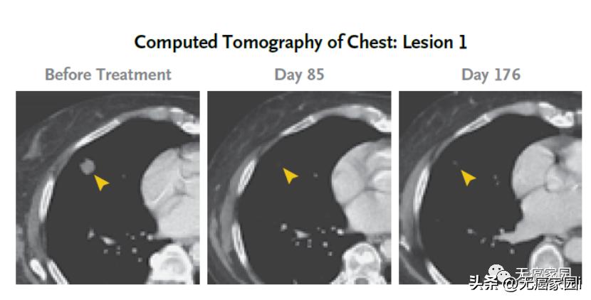 CAR-T、CAR-NK、癌症疫苗、TCR-T等细胞疗法，直击胰腺癌的软肋！
