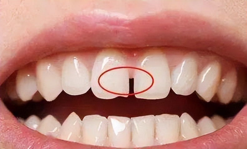 牙龈萎缩牙缝变大怎样缩小牙缝,洗完牙后牙缝大怎么缩小牙缝