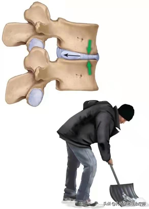 腰椎间盘突出要怎么治疗才好得快,腰椎间盘突出3个方法标本兼治