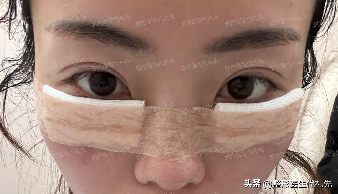 内切眼袋后1-5天恢复图,内切眼袋恢复后对比图片