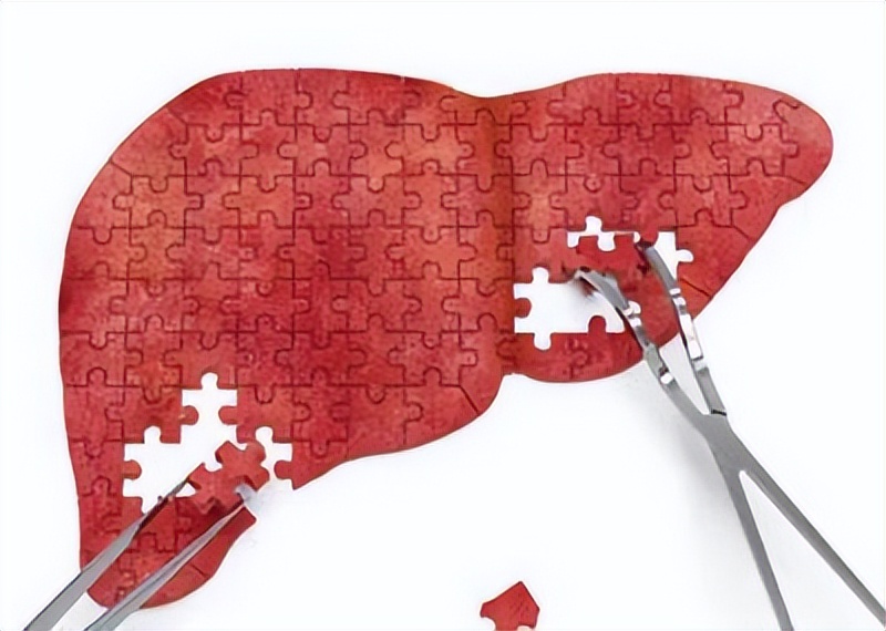 出现肝掌肝硬化的几率大吗,有肝掌是肝硬化几期