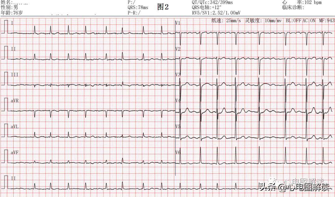心房颤动病人临床表现,心房颤动评分