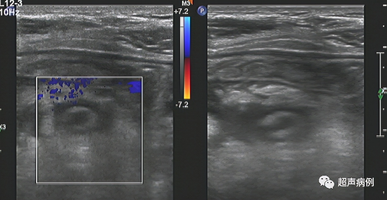 阑尾炎超声下怎么看？哪些知识需要掌握？这里都总结好了