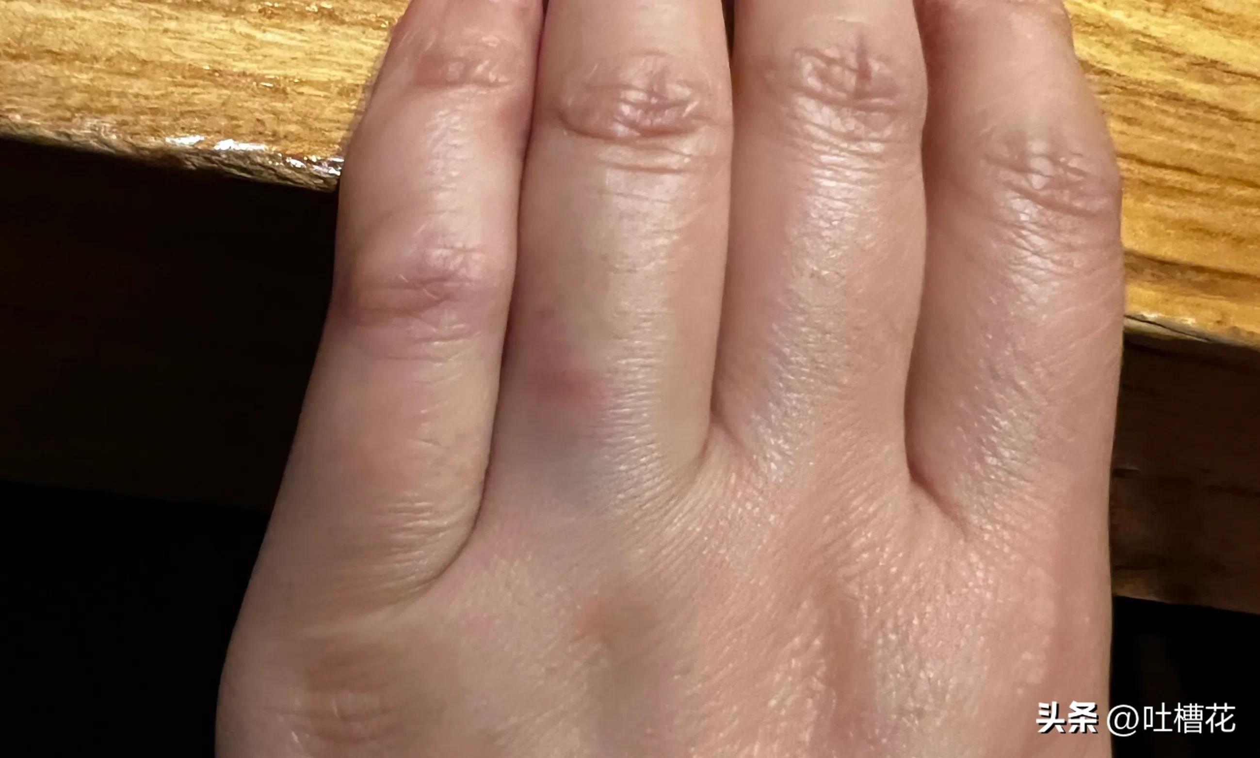 手指受伤了说疼不疼还是痛不痛,手指头受伤了能不能吃火锅