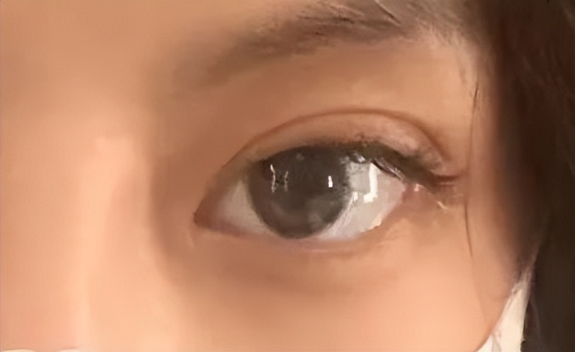 开外眼角优点和缺点,外眼角开的不明显还可以再开吗