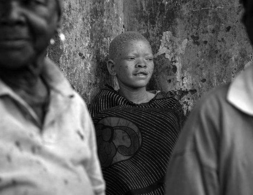 非洲最特殊的人群：血液堪比黄金，遗骸卖上百万，却无法健康成长