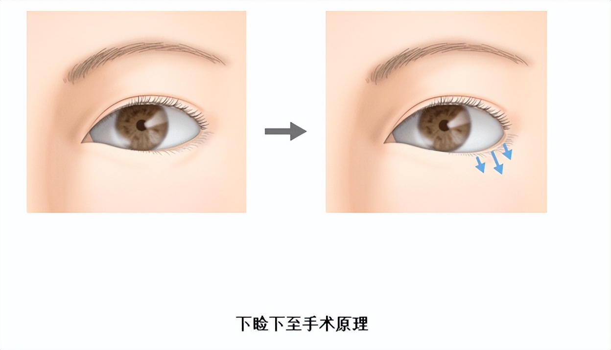 说说下垂眼之“下睑下至术”