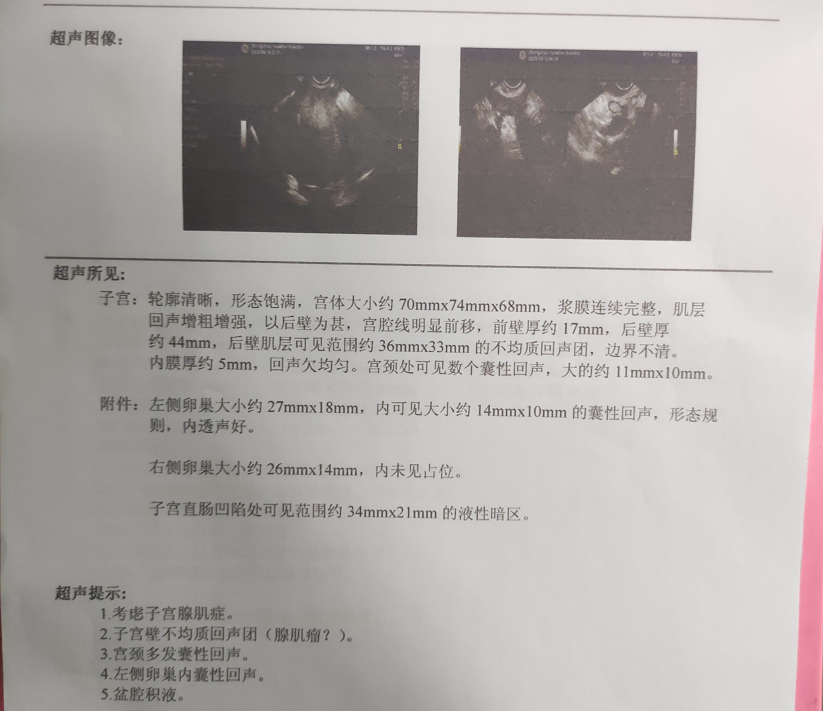 腺肌症容易诱发盆腔炎,腺肌症和盆腔炎同时发生吃什么药